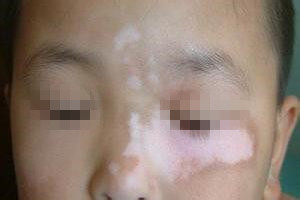 局限型白癜风的具体介绍有哪些