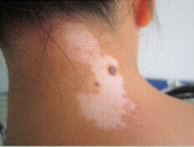 白癜风的初期症状有哪些