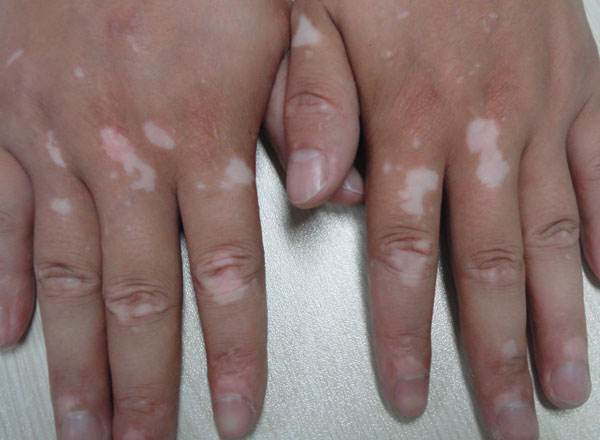 白癜风的主要诱发因素是什么