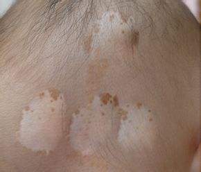 白癜风到底能不能被治好呢