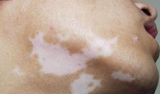 白癜风在发病初期有什么症状