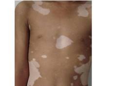 耽误白癜风治疗会引起什么后果