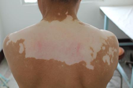 冬季白癜风治疗的优势有哪些